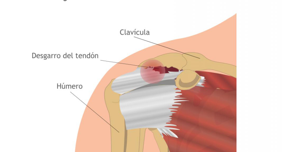 Reparación del manguito de los rotadores